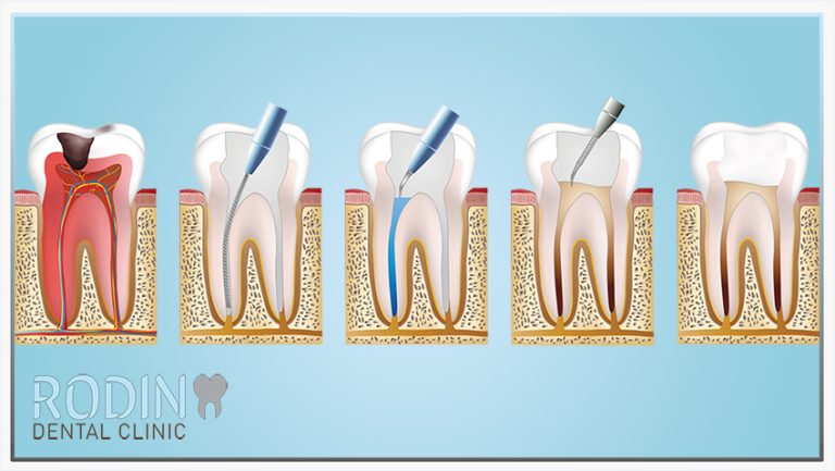 Wortelkanaalbehandeling | Rodin Dental Clinic